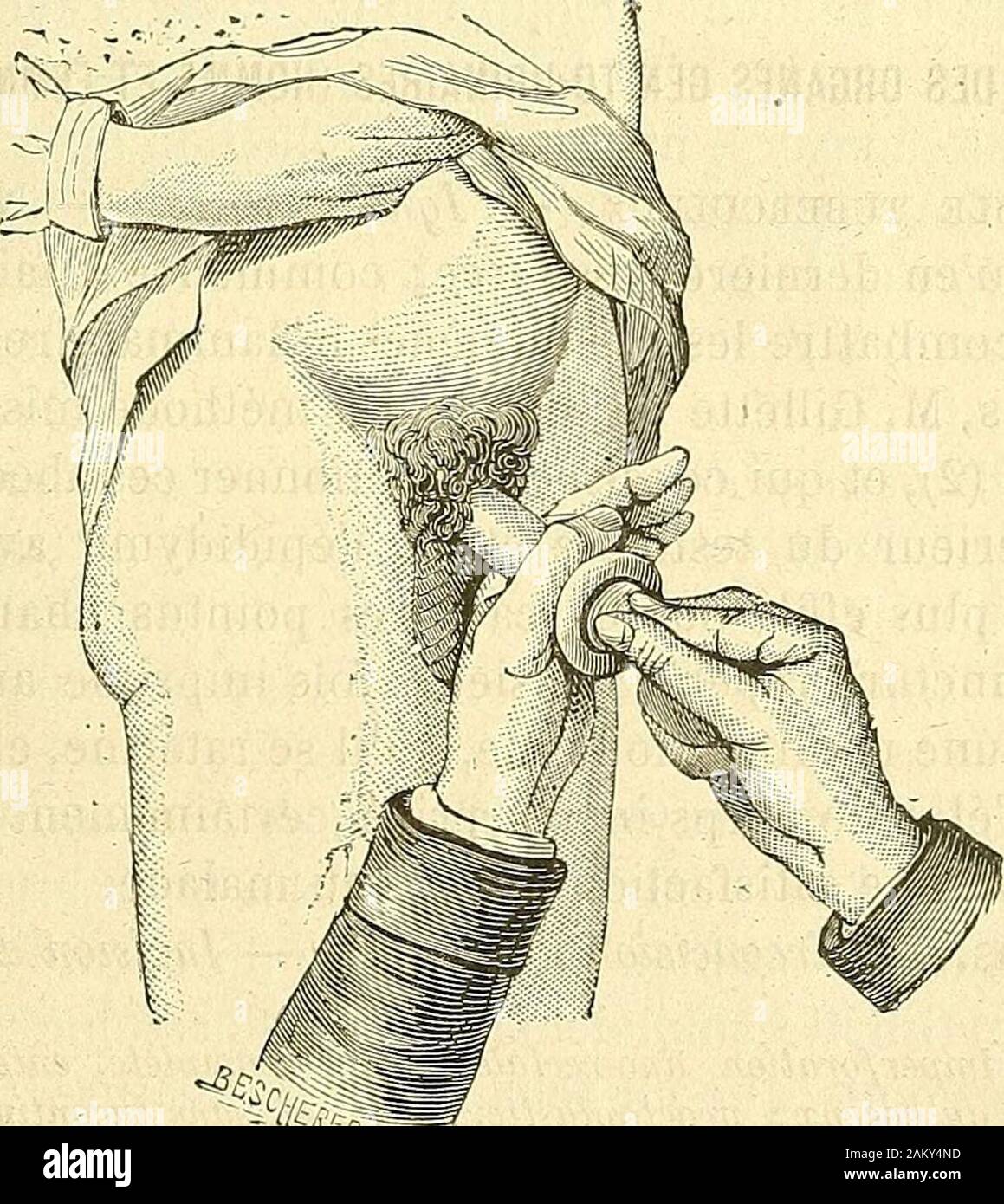 Illustration Of Phimosis: Tightness Of Foreskin Metal Print by