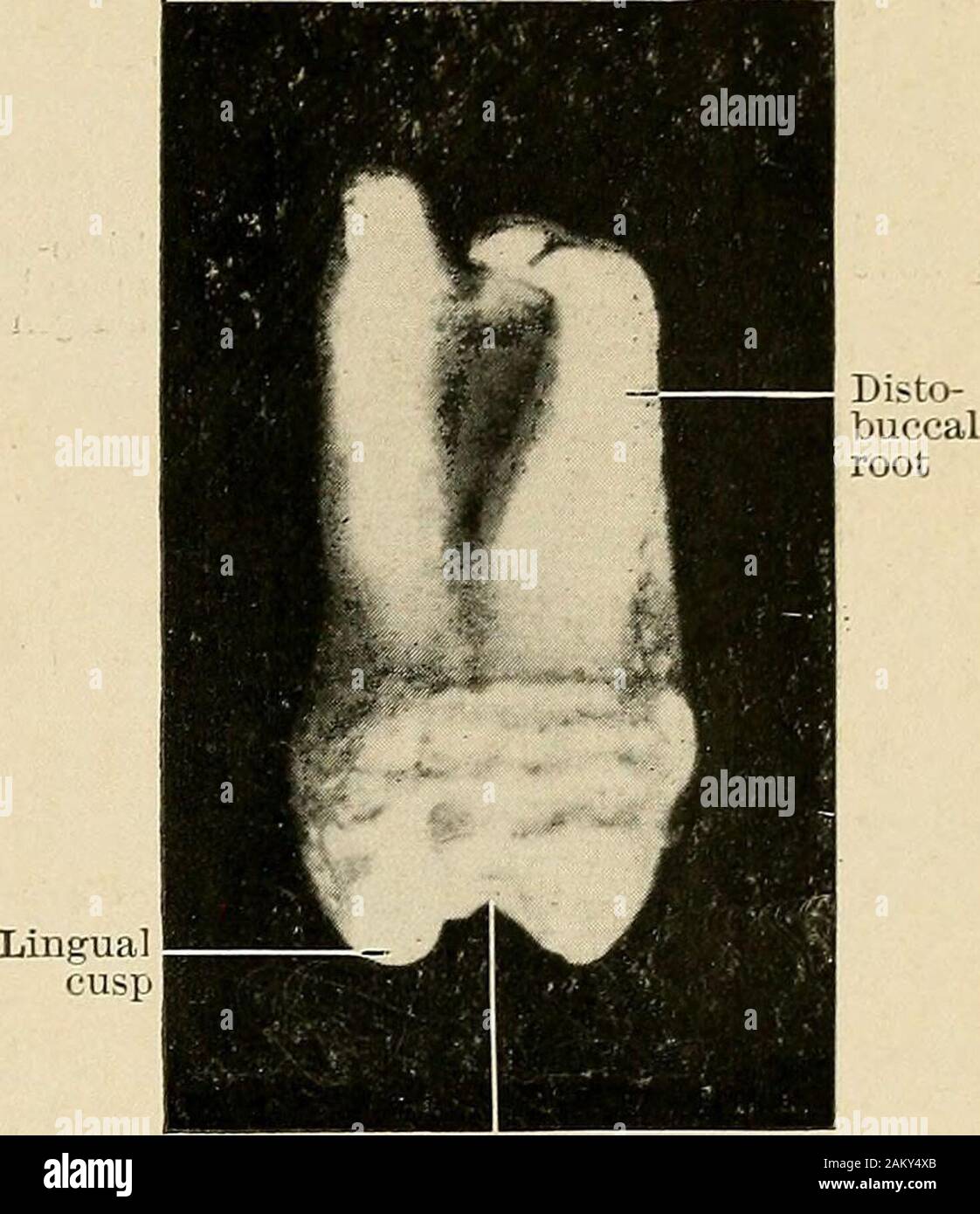 Principles and practice of operative dentistry . Mesial grooveFig. 65