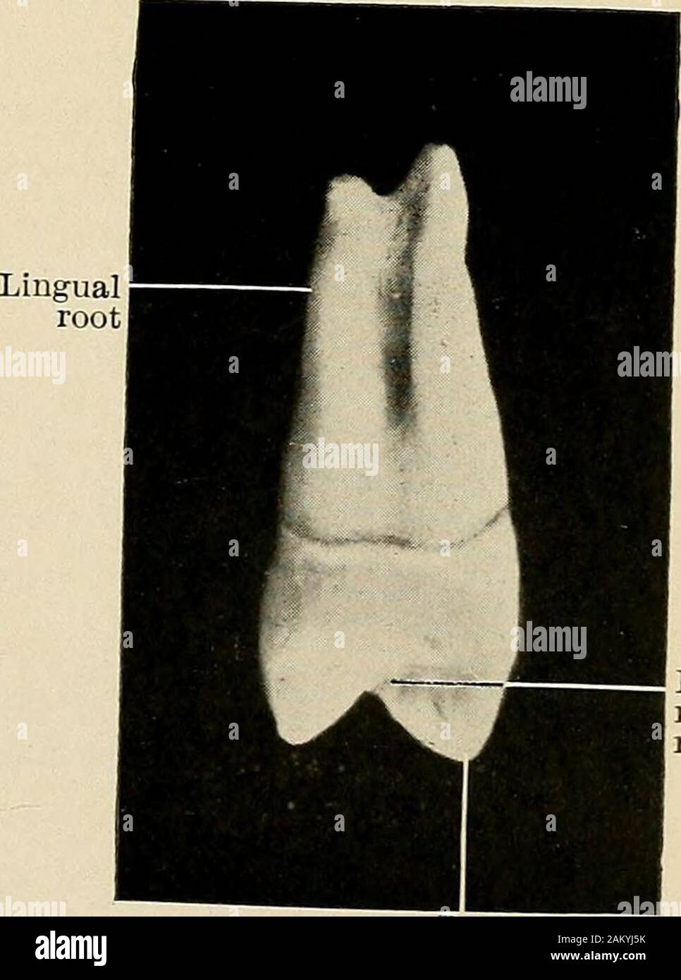 Principles and practice of operative dentistry . Mesio marginal ridge
