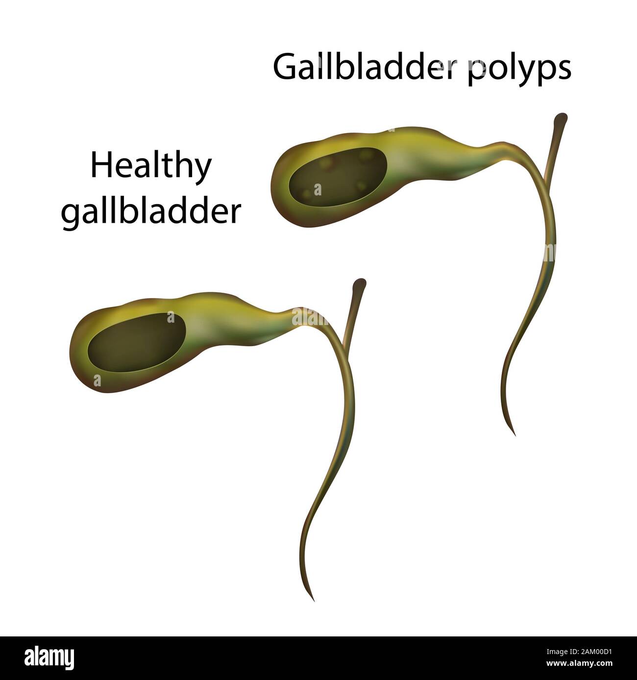 Gallbladder Disease Stages, Anatomy Vector Realistic White | lupon.gov.ph