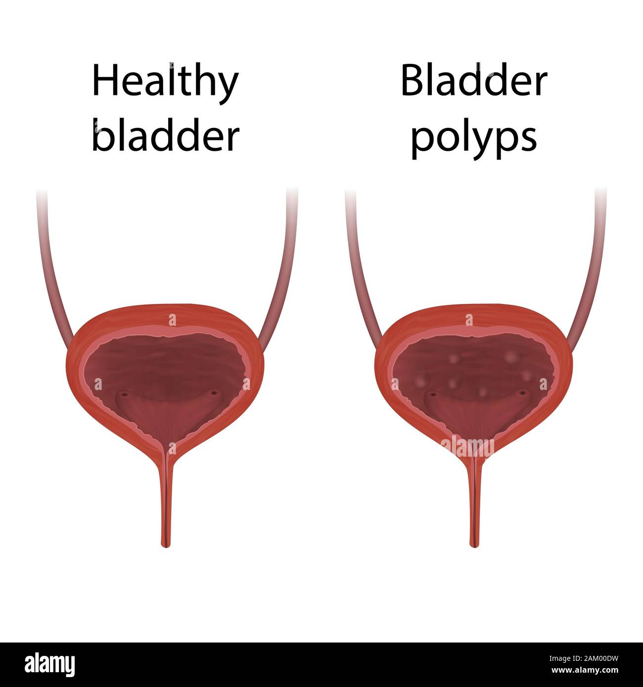 Abnormal urinary bladder hires stock photography and images Alamy