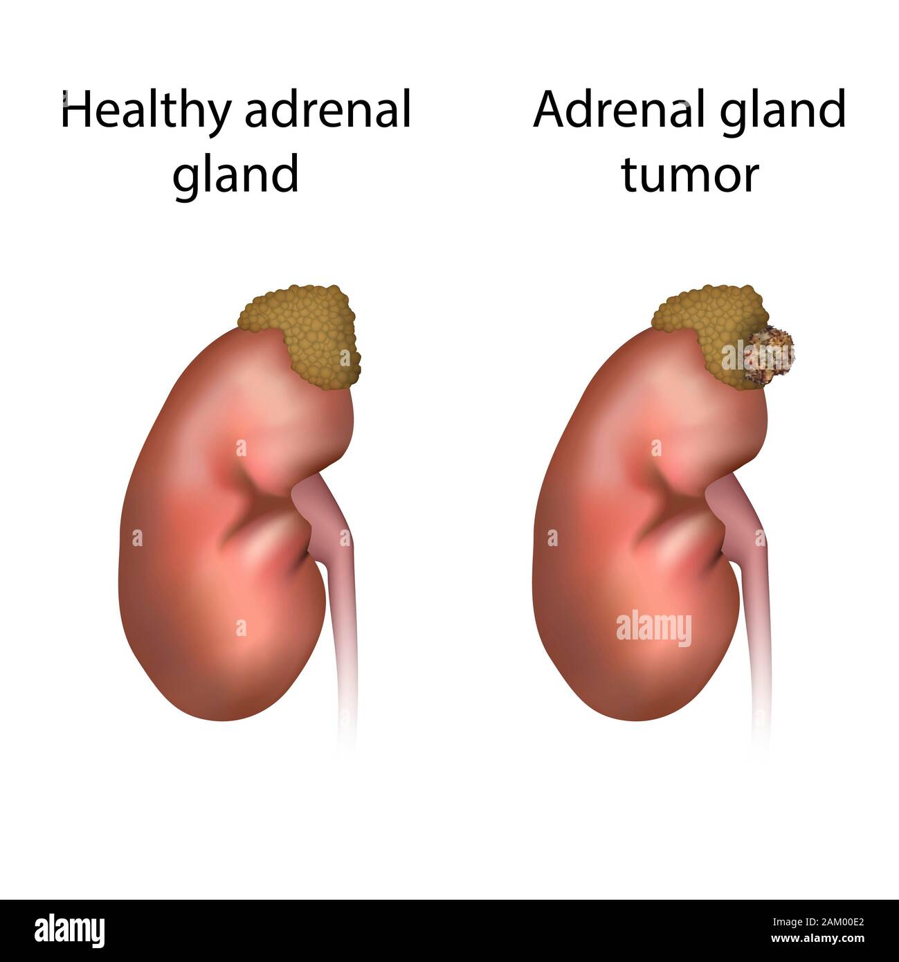 Adrenal gland tumour and healthy adrenal gland, illustration Stock