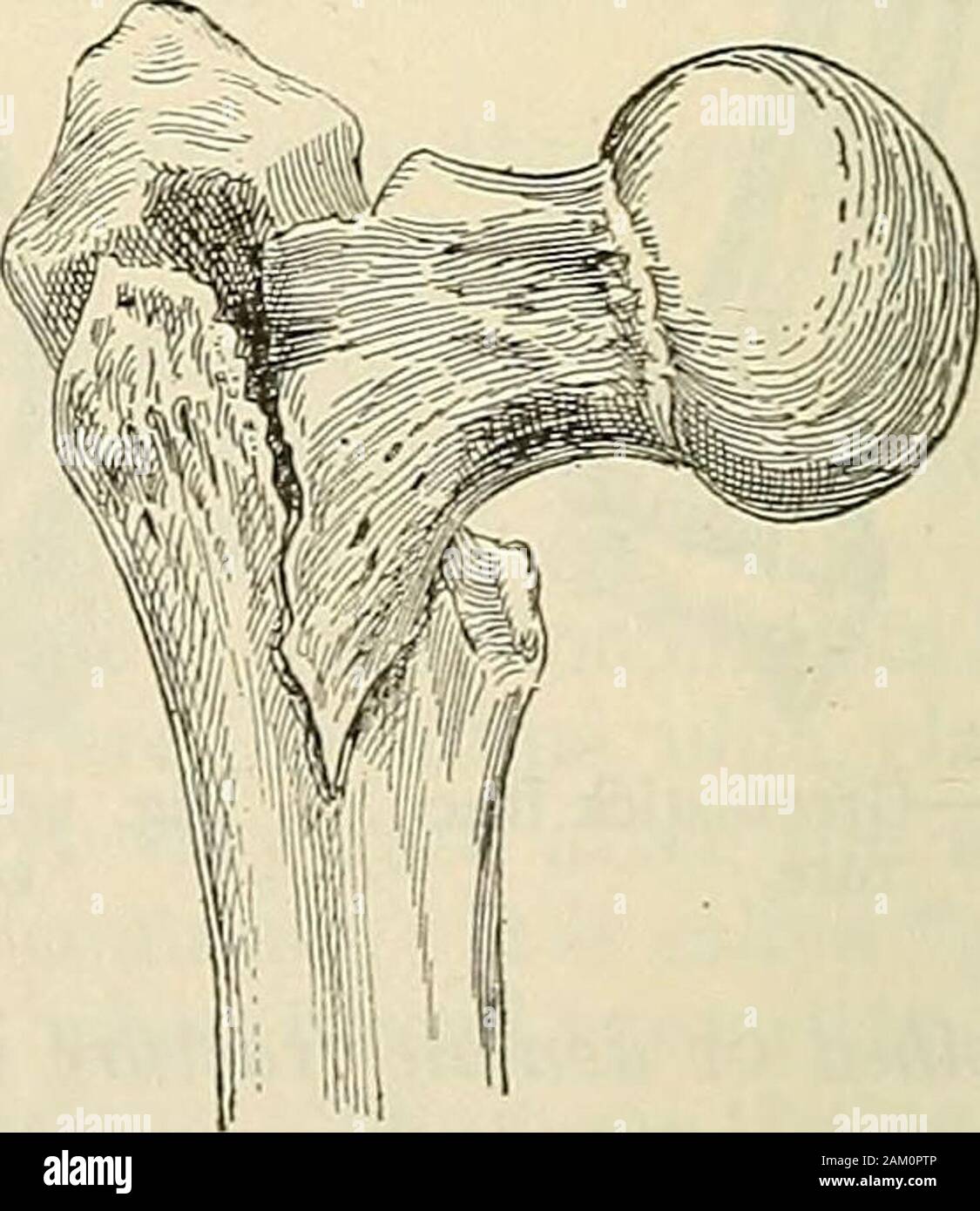 Modern surgery, general and operative . Fig. 267.—^Impacted fracture of