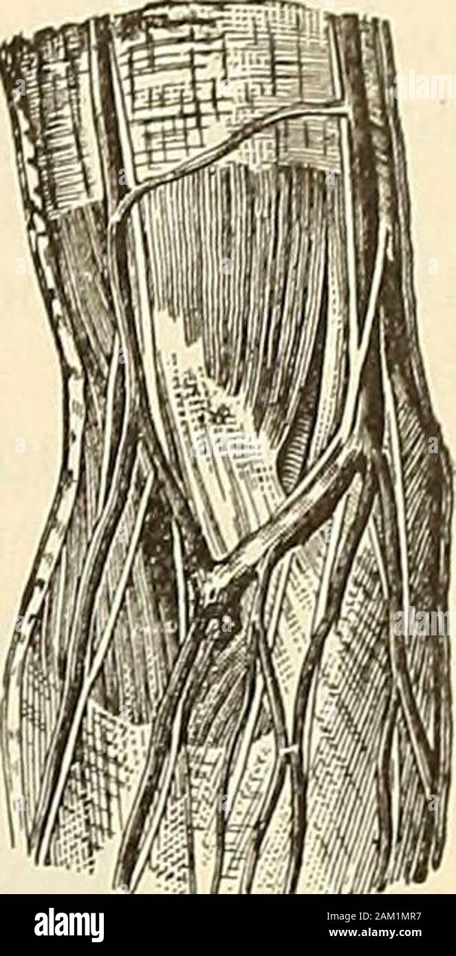 Modern surgery, general and operative . Fig. 230.—Incisions forvenesection (Bernard andHuette). Fig. 231.—Superficialveins in front of elbow(Bernard and Huette). selected. In opening it do not cut too deep, as nothing but the bicipital fascia,separates it from the brachial artery. The median cephalic may be selected(we thus avoid endangering the brachial artery); under this vein lies the externalcutaneous nerve (Fig. 231). Steady the vein with the thumb and open it bytransfixion, making an oblique cut which divides two-thirds of it. Remove thethmnb and allow bleeding to go on, instructing the Stock Photo