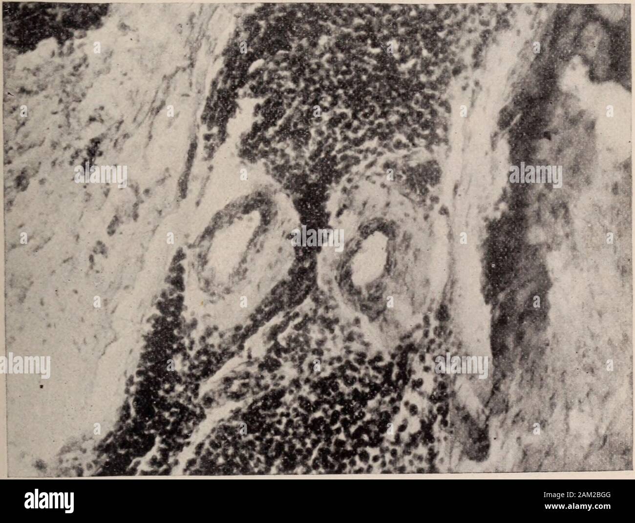 Dental review; devoted to the advancement of dentistry. . Fig. 3. Inflammation of the gum.How susceptible the alveolar process is to interstitial gingivitis Ser when auto-intoxication takes p.ace or drug; po*r ^int^flammation sets in with marked interstitial gmgiviti,absorption and loosening the teeth.       i Journal American Medical Association, June, I9OQ. ORIGINAL COMMUNICA TIOXS. 635 A seamstress bites her thread. Interstitial gingivitis resultswith absorption of the bone and loosening of the teeth. Personswith very low vitality, poorly nourished people, suffering with pro-longed sickness Stock Photo