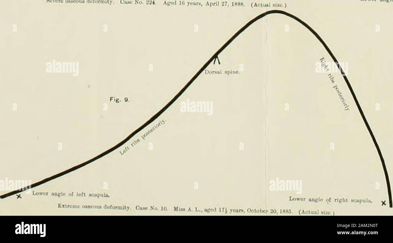 The treatment of lateral curvature of the spine : with appendix giving an analysis of 1000 consecutive cases treated by posture and exercise exclusively, without mechanical supports . PLATE II. Fg. 10. Fig- 11 Stock Photo