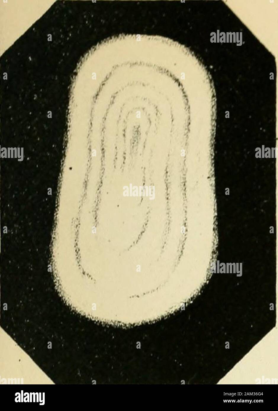 Inflammations et catarrhe de la vessie, gravelle, des divers moyens de combattre ces affections . de Calculs Urinaires. Stock Photo