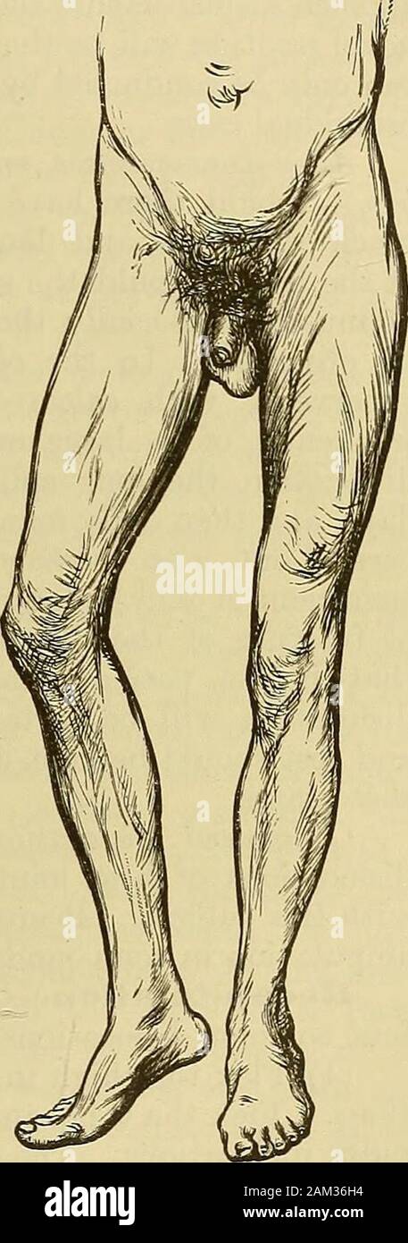 A system of surgery . per-mitted. There is pain in the course ofthe crural nerve, and the head of thefemur makes a marked projection beneathPouparts ligament, which is the dis-tinguishing sign of the accident, and atonce differentiates it from fracture. Treatment.—The leg and thigh areflexed in slight abduction, and thenswept inwards in adduction until nearthe median line; rotation inwards or Fig. «srotation outwards may then be tried, thelimb being extended at the same time.By these means the head of the bone retraces its steps round theacetabulum to the inner side and below, and the final ma Stock Photo