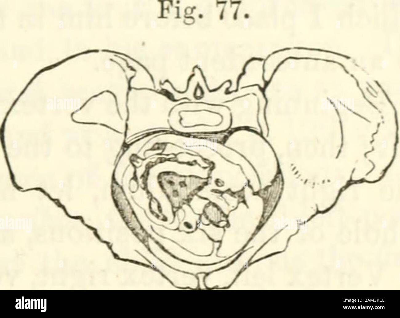 Obstetrics : the science and the art . enerally is found tobore with its head, so as to turn the vertex now forwards, and nowbackwards, until at last it becomes fixed in one position, by gettingunder the arch of the pubis. So common is it to observe the child todescend with the vertex opposite to the left acetabulum, that that istaken or counted as the first position of a vertex presentation; andBaudelocque, whose authority on this subject is much followed in theUnited States, enumerates a second, third, fourth, fifth, and sixth posi-tion, the enumeration or order being founded on the supposed Stock Photo