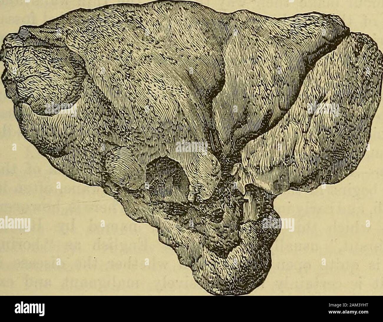 A system of surgery . eys and Windle.) size (Fig. 368); those in the upper jaw are sometimes as big as abantams egg, and occasionally exceed this size. Some large odon-tomes from the antrum have been described asexostoses, but careful histological examinationshows that they are composed of dentine,cenientum, and enamel (Fig. 369). To the present time upwards of thirty com-posite odontomes are known; of these two-thirds were situated in the mandible, and the.remainder occupied the maxillae. The largestspecimens were from the upper jaws, and insome of them the clinical facts were veryextraordina Stock Photo