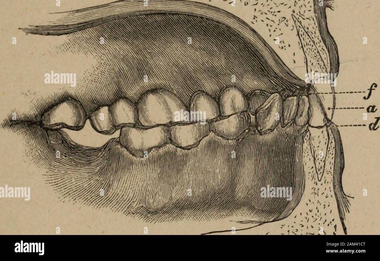 Lectures on operative dental surgery and therapeutics . til the ad-vance of age determines their further tolerance in themouth. In the normal articulation, the superior incisorsslightly overlap the inferior, and, as an ill-constructed pairof shears may be made to destroy their own edges, in likemanner an abnormal closure of the maxillae may cause theincisors to abrade each other. Where this exists, treat-ment will consist in restoring the original articulation, aspreviously described. Such then are the two recognised agents in causingabrasion; but I shall now describe a case in practice pro-ce Stock Photo
