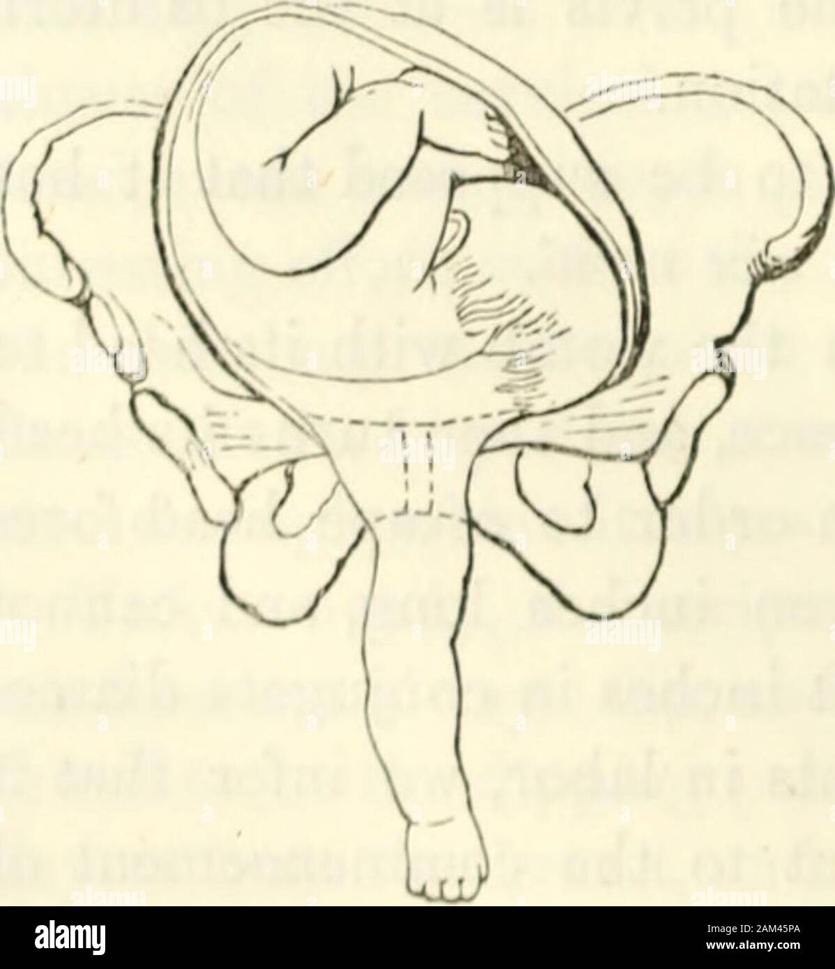 Obstetrics : the science and the art . nal point is the sacrum of the foetus. For the shoulder presentation,the cardinal point is the whole head of the child. As to the head presentation—it may deviate, and allow a shoulderto come to the os uteri: but this is a mere accident of a cephalic pre-sentation : an accident that has arisen from the impinging of the headupon the margin or brim of the pelvis, whence it has glanced upwardsto the iliac fossa, permitting the shoulder to take its place. This is to be seen by inspecting the cut, in whichthe childs head, which originally pre-sented, has devia Stock Photo