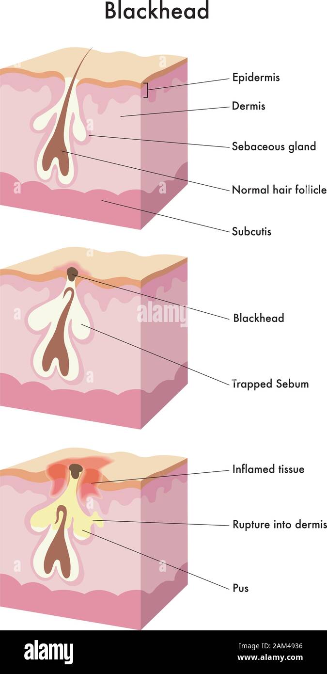 Medical illustration of the formation of blackhead. Stock Vector