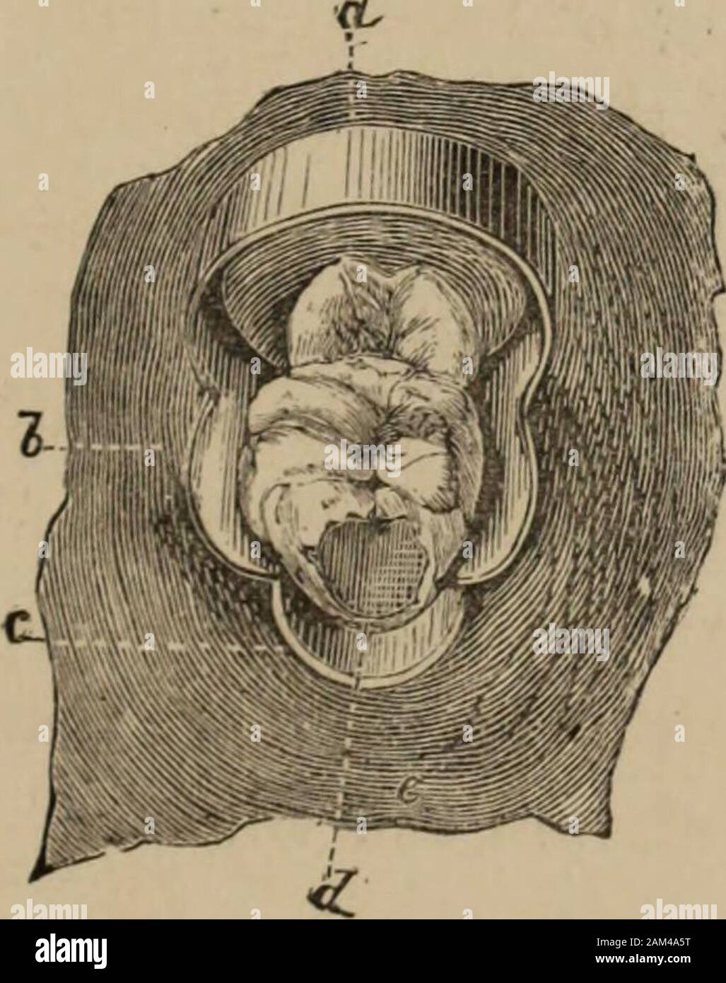 Lectures on operative dental surgery and therapeutics . atein position, as applied to the tooth (Fig. 7.) This clamp embraces the cervical portion of the toothon the buccal and lingual sides, and affords support fora secondary spring which passes ever the posterior portion 27 of the tootli, and rests upon the slirunken gum. Theprimary spring is attached at sncli an angle to the grasp-ing plates, that it lies near the first bicuspid, and quiteout of the way; also out of the range of light. With theapplication of an ordinary clamp, at least one half of thecavity would be bridged by the rubber, l Stock Photo