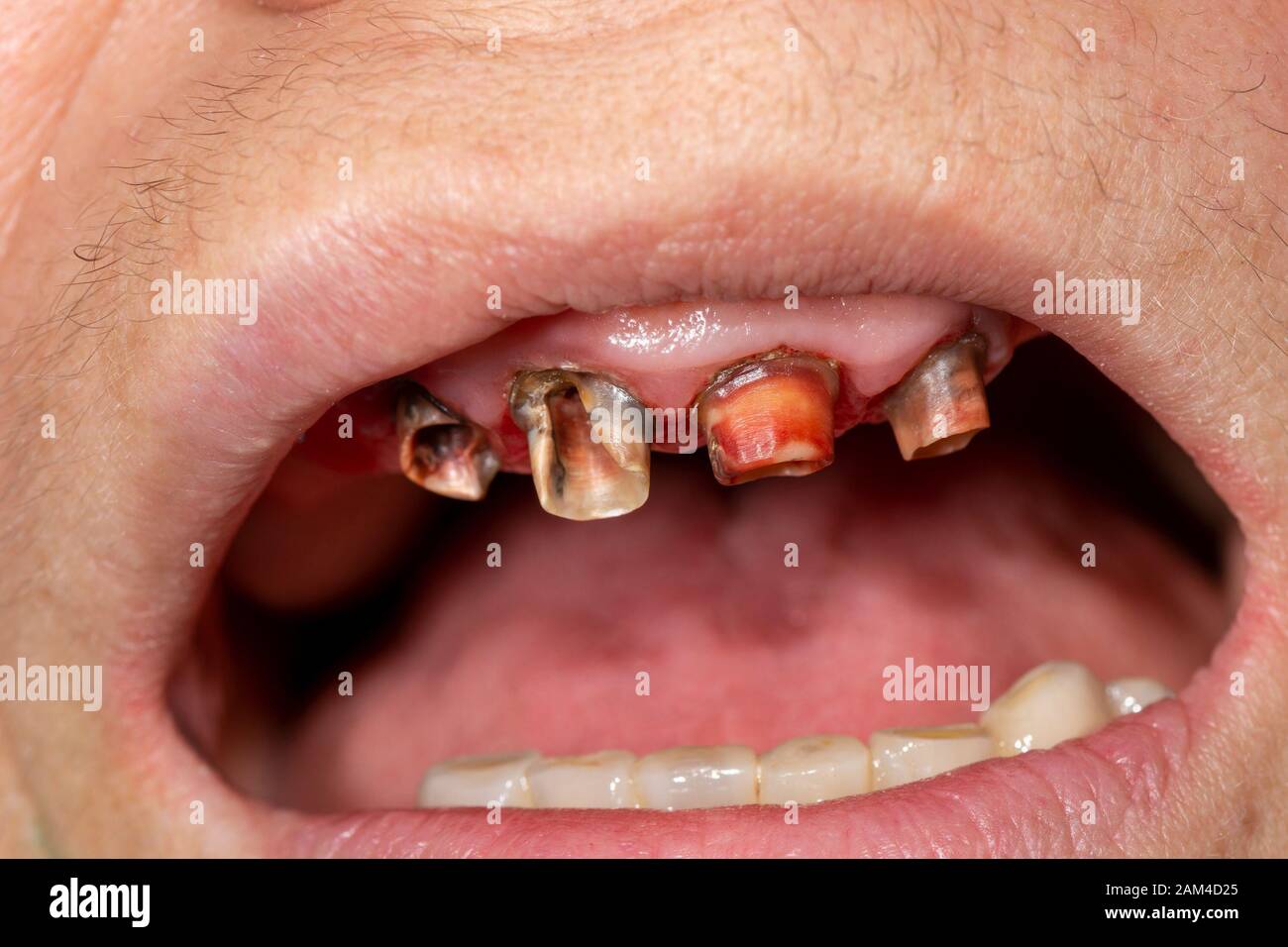Roots Of Teeth Stock Photos & Roots Of Teeth Stock Images - Alamy