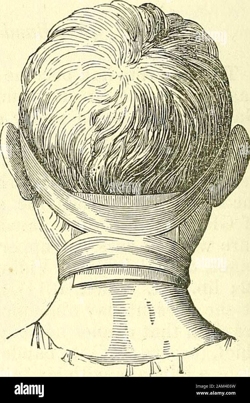 New elements of operative surgery . rejected at present. So also with the discrimen, the figured, {figure^and the knotted, {noue^ bandages. D. The packers knot, (noeud d^emballeur.) When bleeding by thetemporal artery was much practised formerly, they had recourse,in order to stop the hemorrhage, to a sort of compression, whichwas rendered exceedingly solid by forming, upon graduated com-presses, different crossings called the packers knot, (nceud d^em-halleur.) For that purpose, it w^as necessary to have a bandage offive yards in length, about an inch in width, and rolled up in twoheads. The Stock Photo