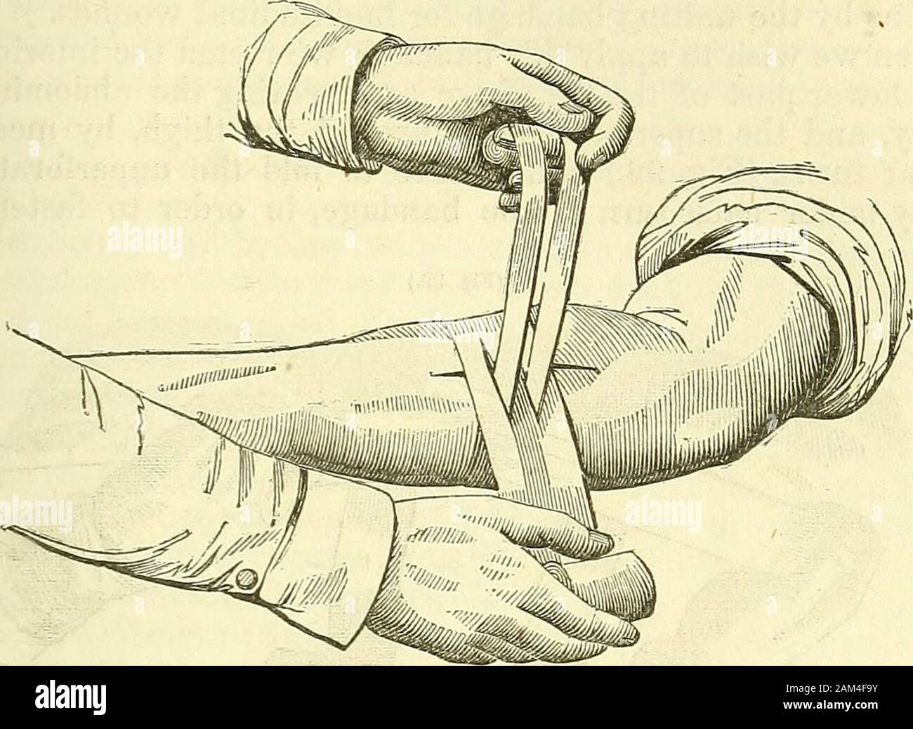 New elements of operative surgery . rossedin front of the wound, whose two lips are drawn together. Theyare afterwards conducted backward, where the small head mustbe made to terminate, and in such manner that there are stillsome turns to spare of the larger one. It is often, also, useful toplace under this bandage a graduated compress, of greater or lessthickness, on each side, and at some distance from the wound. Wethus force the deeper tissues to come into contact as well as thesuperficial layers. A more regular bandage than the preceding, is that which ismade with a long bandage, the extre Stock Photo
