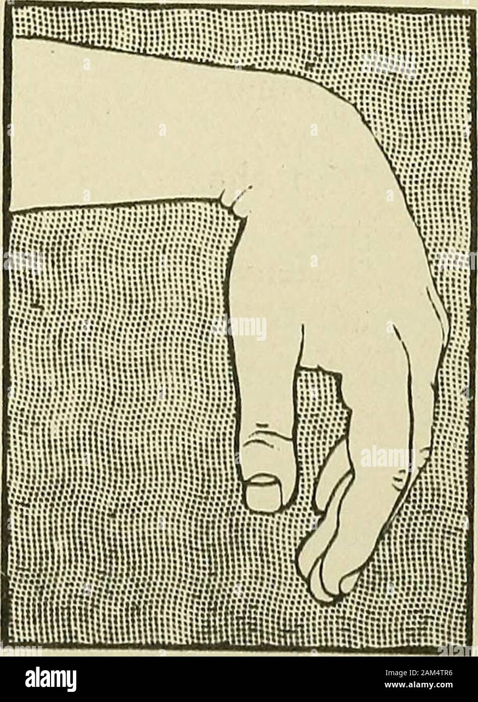Slight pronation shop