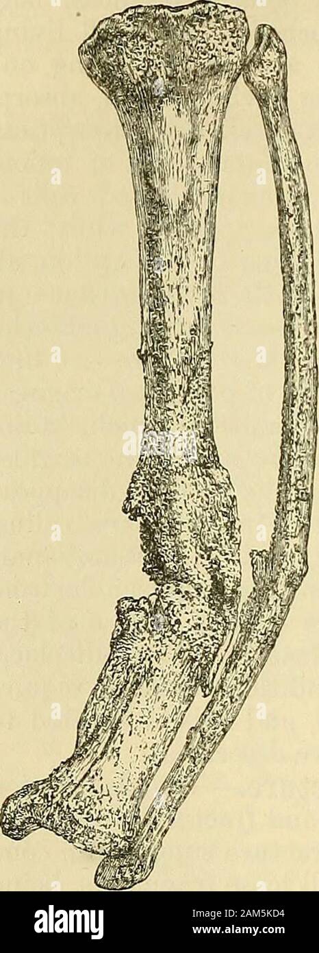 Bone Callouses A system of surgery . aemorrhage and late accidents to vesselsare ...