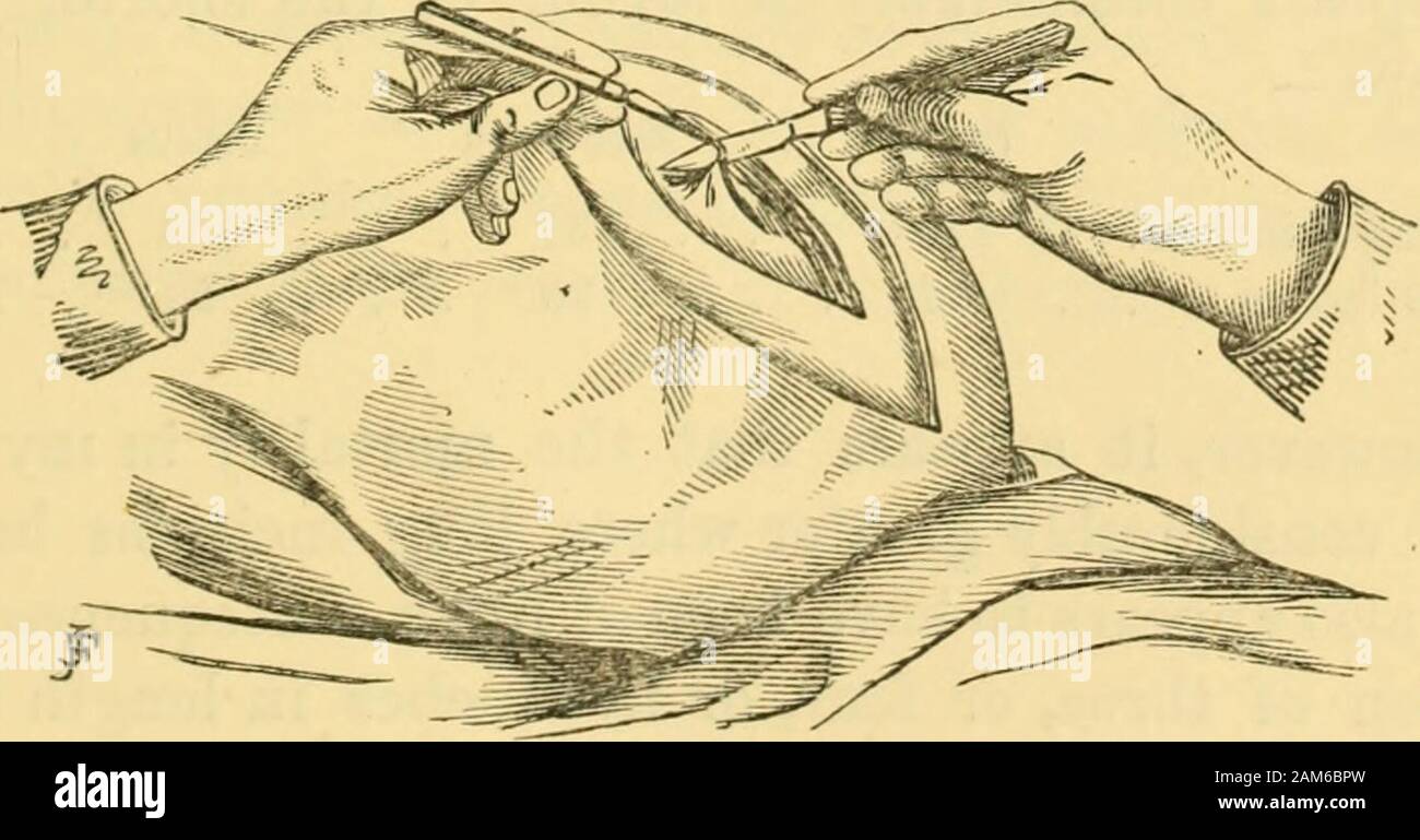 Peritoneal cavity fluid hires stock photography and images Alamy