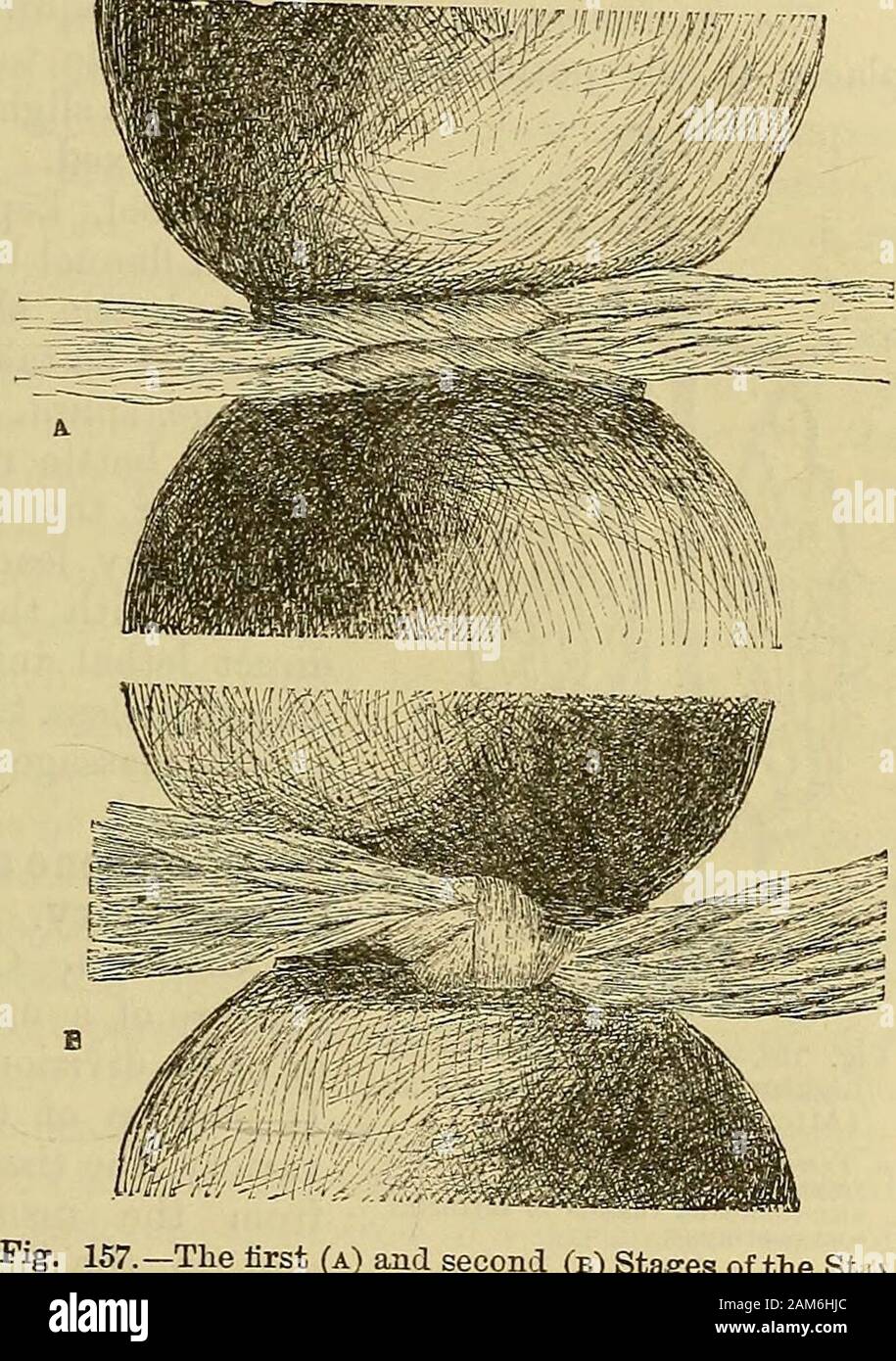 A system of surgery . la-tion is not established,the part dies, under-going  the changes de-scribed as dry gan-grene. More usuallyblood is carried into  the empty vessels by the numerous anastomosesthat exist almost