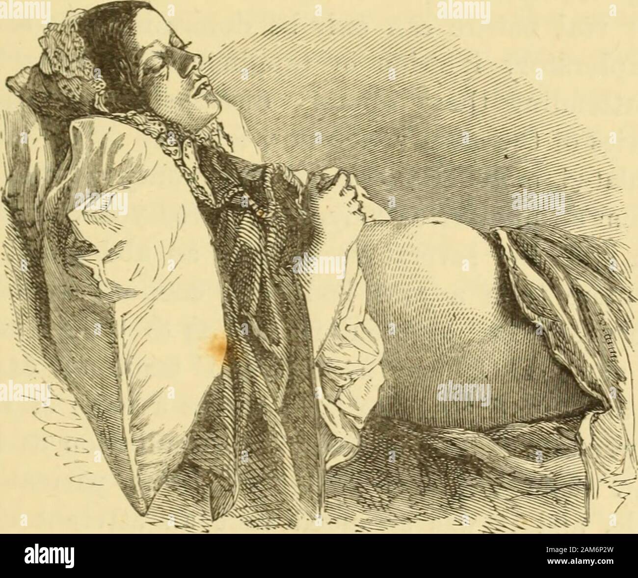 Diseases of the ovaries : their diagnosis and treatment . friends, and even some medical, friends who saw her with me,that she had no abdominal tumour. The tympanitic resonance CHLOROFORM IN TYMPANITES. 145 on percussion was, of course, the leading element in thediagnosis; but the most convincing test was the complete sub-sidence of the swelling, and the flattening of the abdomen whenthe girl was fully under the influence of chloroform. The pho-tograph from which the second drawing was taken was madewhile she was completely narcotised. The arched abdomen isseen to have been quite flattened, an Stock Photo