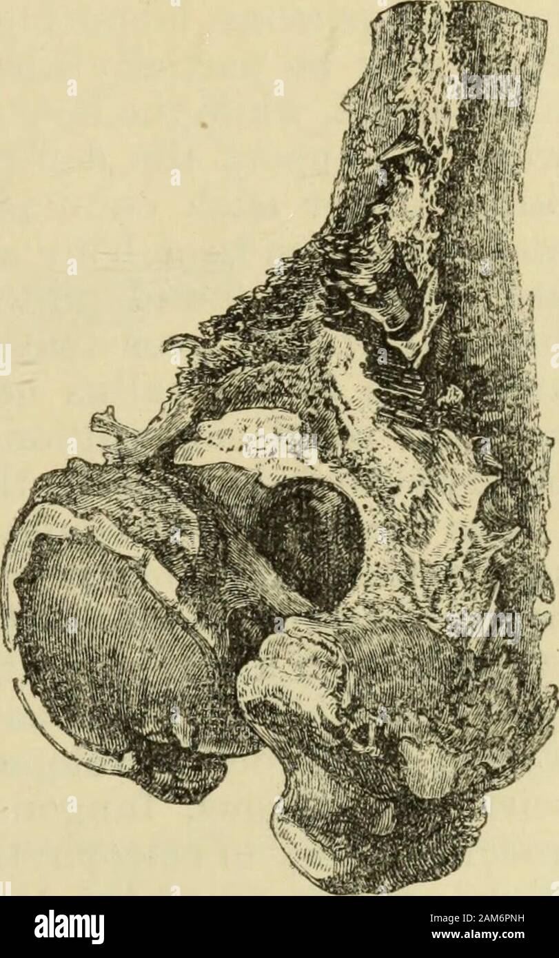 Manual of pathological anatomy . y process Fio- 191. in the superficial part of the bone,and in the periosteum ; and hence itis very commonly found adjoiningand surrounding not only portionswhich are inflamed, carious, ornecrosed, but also spots of boneaffected with various other diseases,which in some stage of their exist-ence have occasioned a reaction inthe tissue of the bone. Thus wemay refer the osteophyte, in anindividual case, to simple inflamma-tion, to iheumatic or gouty inflam-mation, to syphilis, to new growths,or other causes. The diffused and fibre-reticularosteophyte of Lobstein, Stock Photo