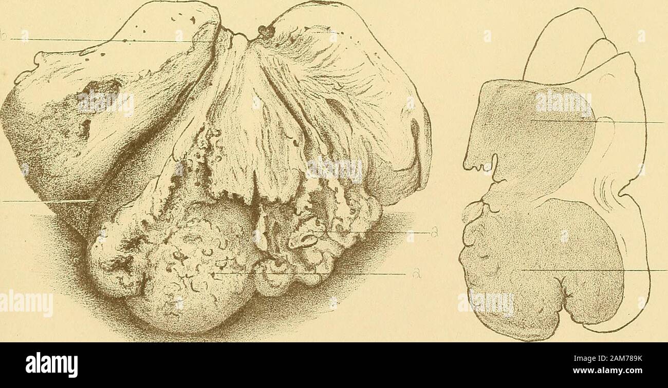 Über den Krebs der Gebärmutter : . Tafel XI. Tafel XL Fig. 1. Mikroskopisches Bild des auf Taf. X., Fig. 3 abgebildeten Krebses. a. Krebs. b. Uteruswand. Fig. 2 zeigt die Entwickelung der Neubildung aus den Drüsen. a. Teil einer Drüse, die vollständig carcinomatös ist. b. Teil Drüse, noch von Cylinderepithel bekleidet. c. Uebergang des Cylinderepithels in Carcinom. (Auf Taf. XIV. sieht man diesen Uebergang bei stärkerer Vergrösserung.) Fig. 3. Schnitt durch den Schleimhautpolypen von Fall XXVII., der krebsigdegenerirt ist. a. a. a. Stiel mit Cylinderepithelbekleidung. b. b. b. Kappe von Platte Stock Photo
