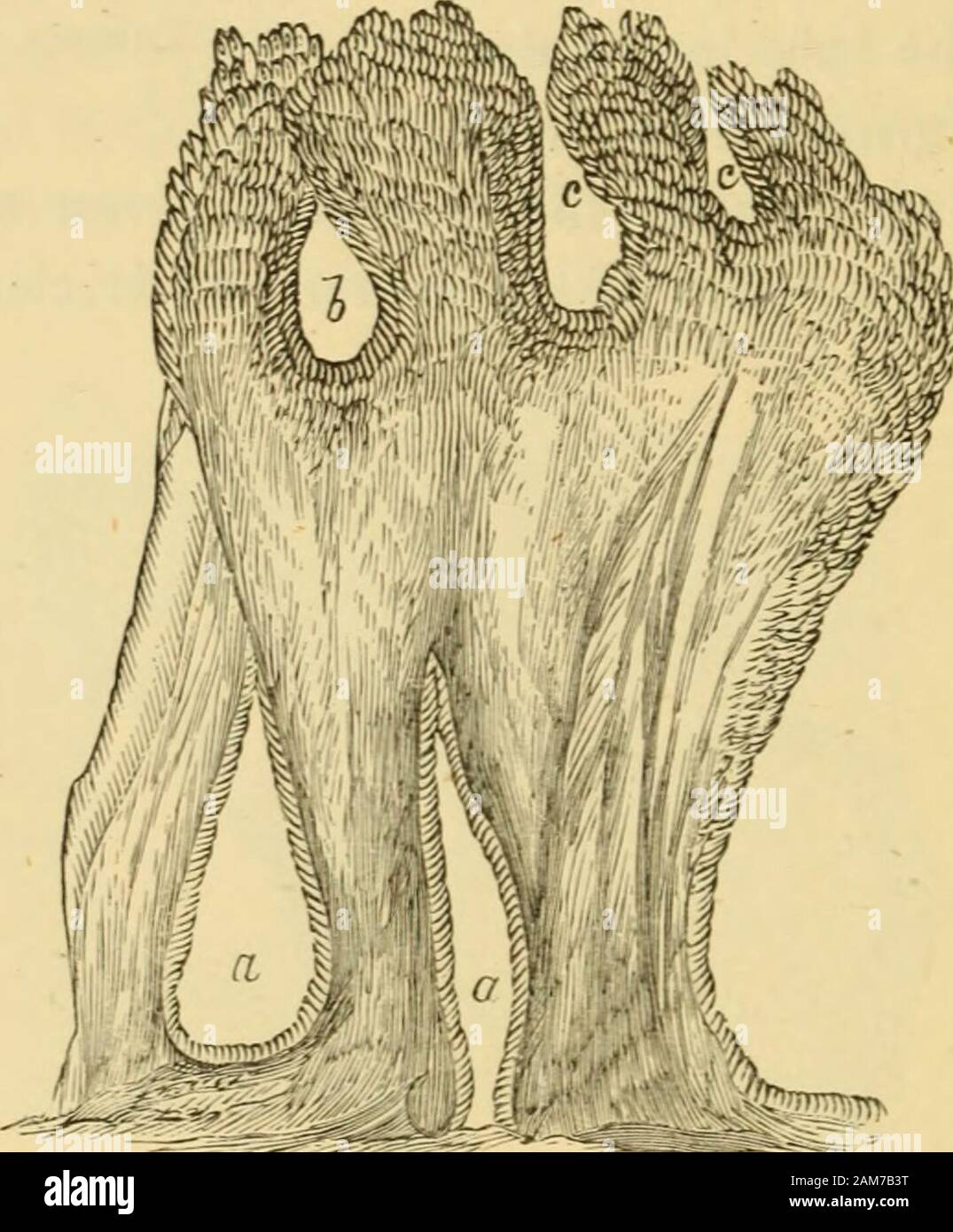 Diseases of the ovaries : their diagnosis and treatment . Formation of Secondary Cysts, by Tubular Processes given off from Cysts in thickerportions of Stroma. ( x 2.i0 Diam. reduced.) 4.s WILSON FOX ON OVARIAN CYSTS. The third class of cases investigated by Dr. Fox were thosewhere cysts are found associated with cauliflower growths spring-ing from the interior of the parent cysts. This class, to whichthe theory of the origin of cysts from single cells has beenchiefly applied by Rokitansky, has received a different explana-tion from Dr. Fox. He describes these growths as solidmasses, consistin Stock Photo