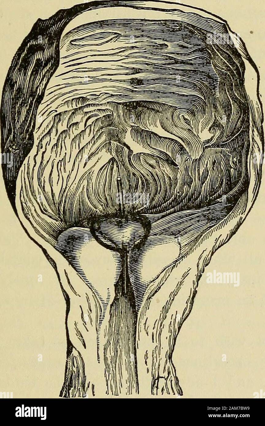 A Non Surgical Treatise On Diseases Of The Prostate Gland And Adnexa The First To Become Indurated And Enlarged Hypertrophy Of The Prostate 129 And Owing To Its Position It Serves