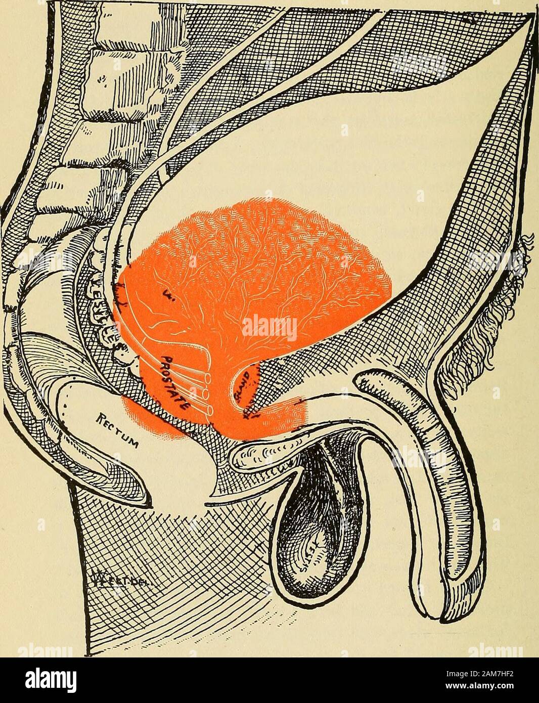 A Non Surgical Treatise On Diseases Of The Prostate Gland And Adnexa Ous This Disease Of The Gland Is One Of Passive Ve Nous Congestion Soft Submucous Infiltration And A Swollenenlargement Of The
