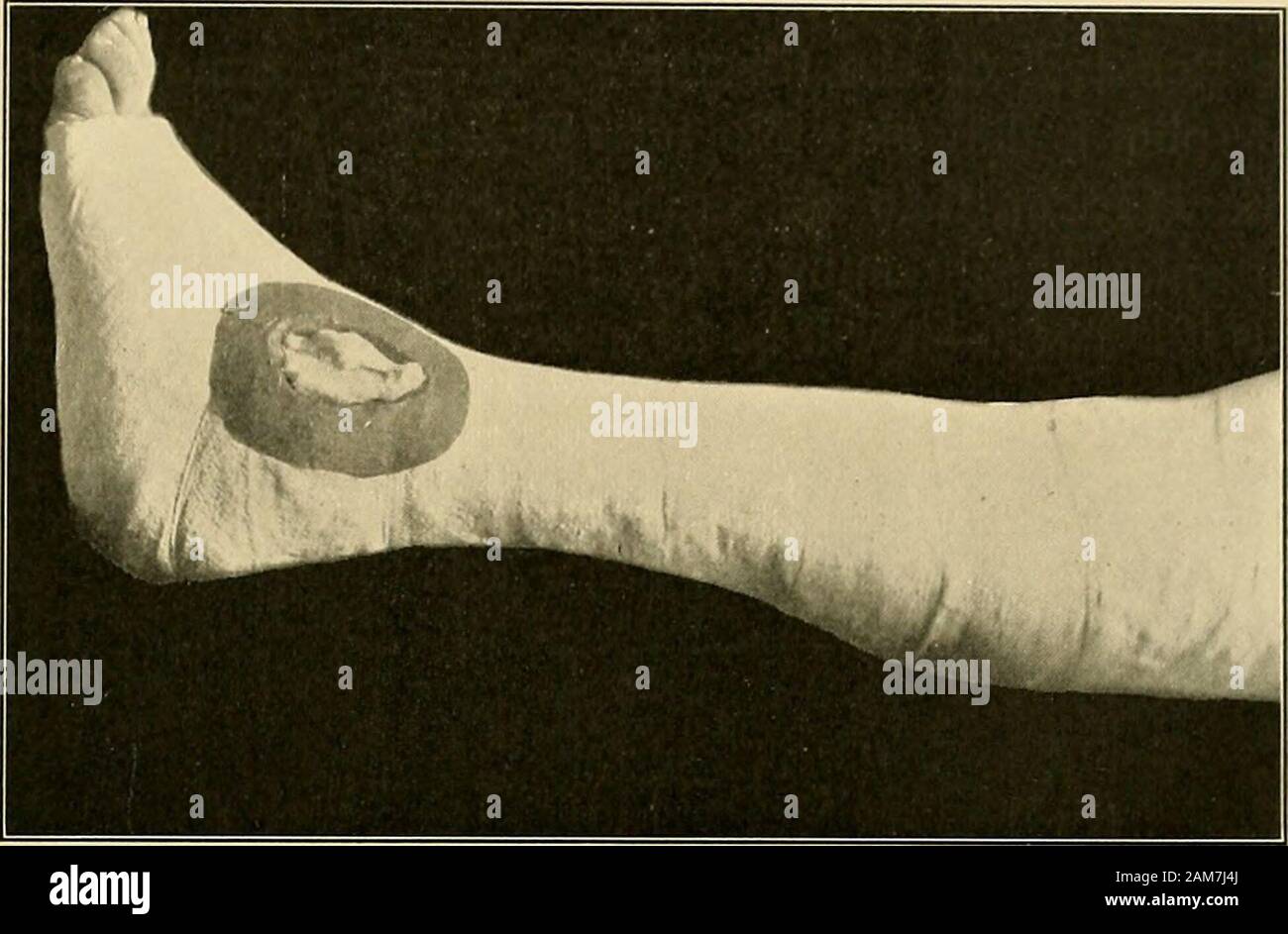Open fracture left leg hires stock photography and images Alamy