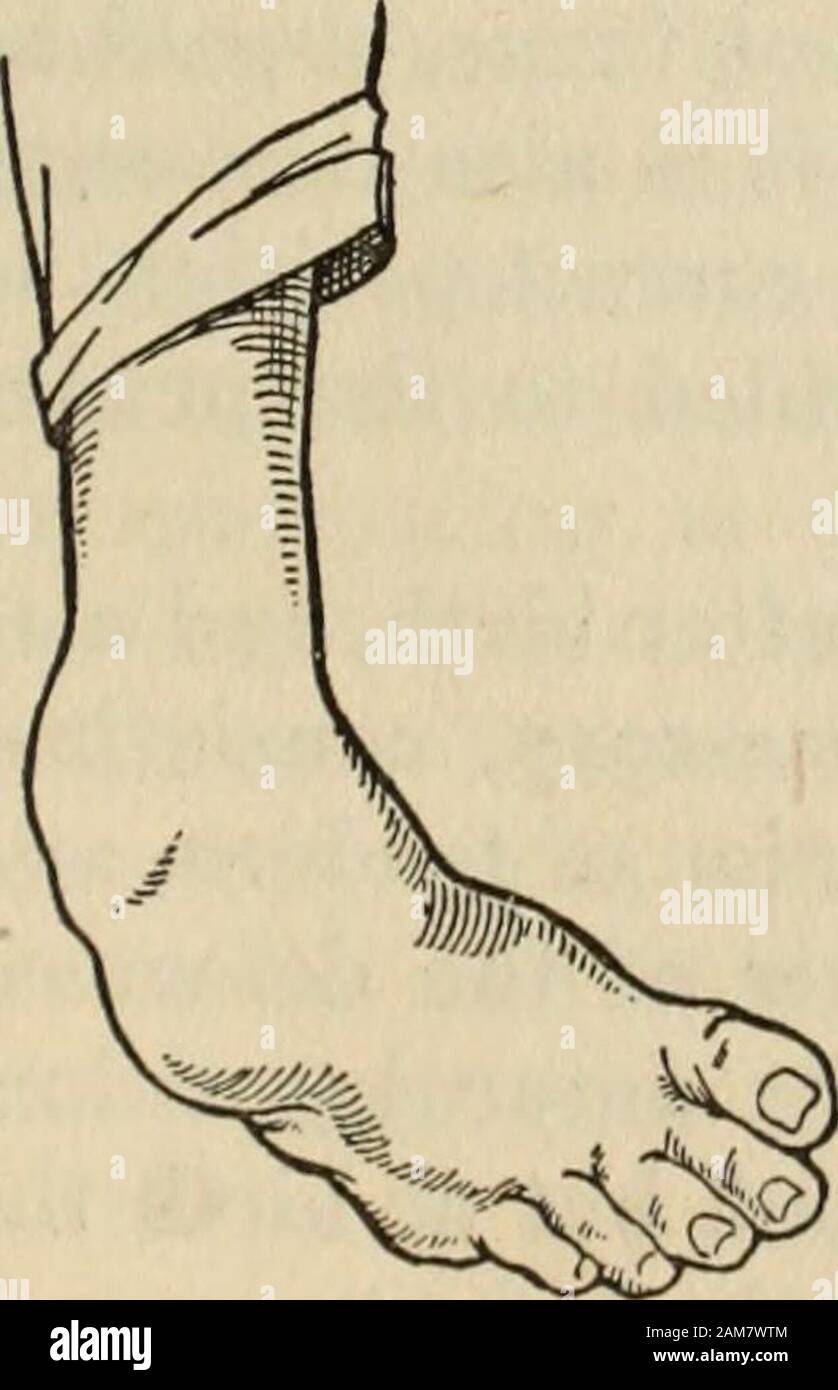 Health Knowledge A Thorough And Concise Knowledge Of The Prevention Causes And Treatments Of Disease Simplified For Home Use Talipes Equinus Talipes Equino Varus These Are Usually Com Bined The Heel Being