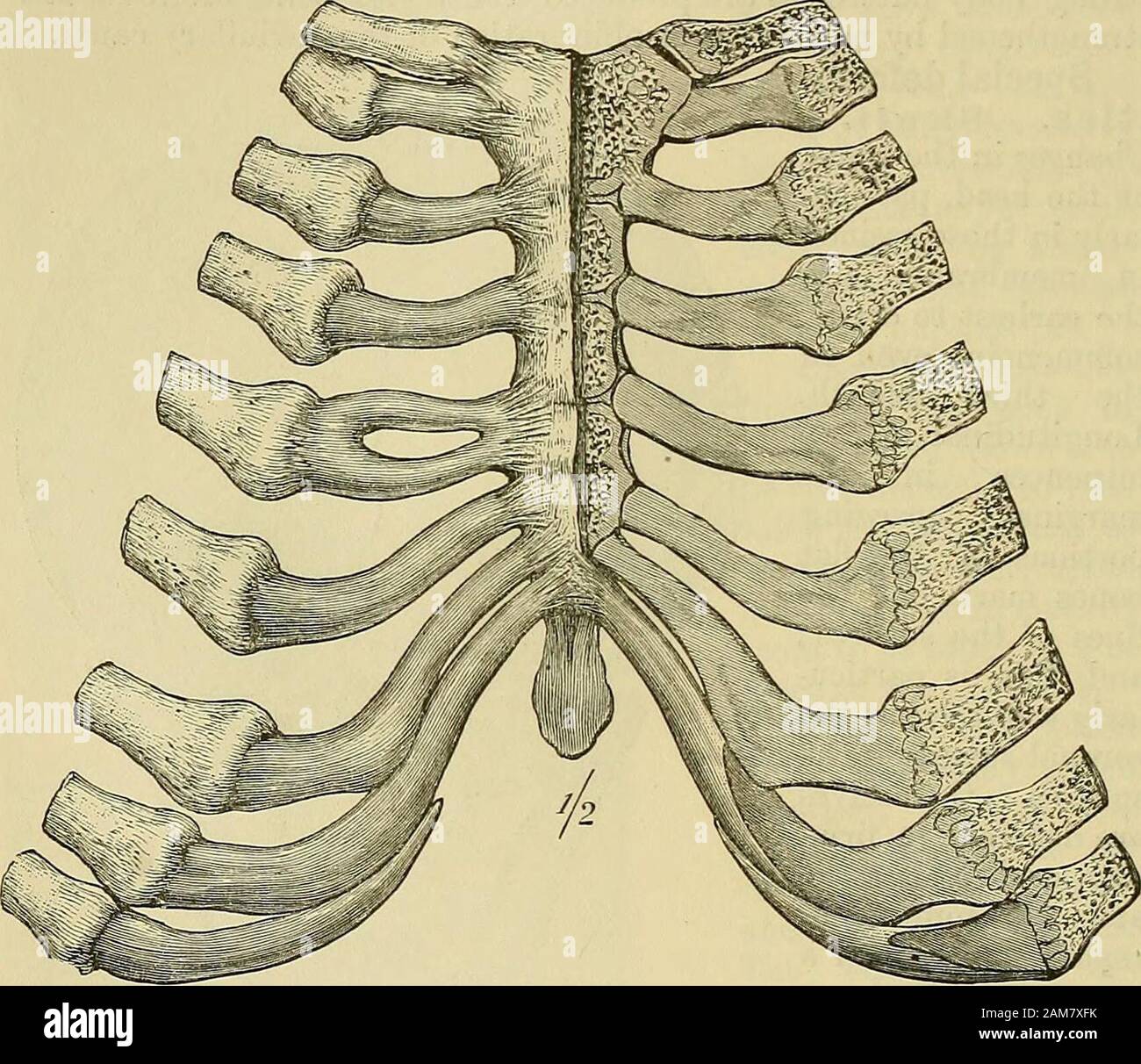 A system of surgery . Fig. 73.—Skull of Rickety Child, illustrating