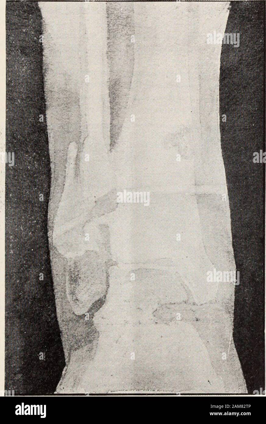 New Yorker medizinische Monatsschrift . rund der Photographie, die Tibia an der betreffenden Stelletrepanirt, die typischen tuberculösen Granulationsherde gefun-den, durch Ausmeisselung entfernt, und so das Leiden zur Aus-heilung gebracht, bevor das Fussgelenk inficirt wurde. Die 3. Platte (Figur 3) zeigt Ihnen eine alte complicirteFractur mit Fistelbildung. Durch mehrmalige Necrotomie wurdeeine völlig reine Knochen wunde geschaffen, welche trotzdemnicht zur Ausheilung kam. Die vorgenommene Röntgen-Photo-graphie zeigte drei Zoll oberhalb des Fussgelenkes und etwa einund einen halben Zoll oberh Stock Photo