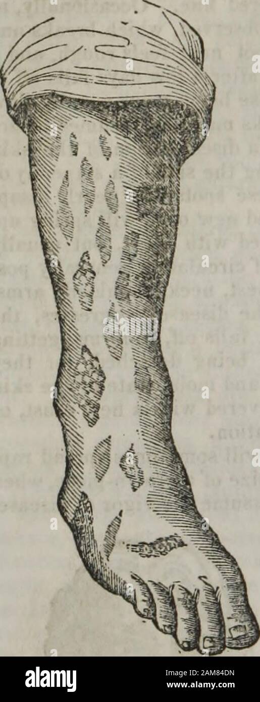 Porneiopathology : a popular treatise on venereal and other diseases of the male and female genital system : with remarks on impotence, onanism, sterility, piles, and gravel, and prescriptions for their treatment . 100 A POPULAR TREATISE. The shoulders, arms, andwrists, also present a somewhat Stock Photo