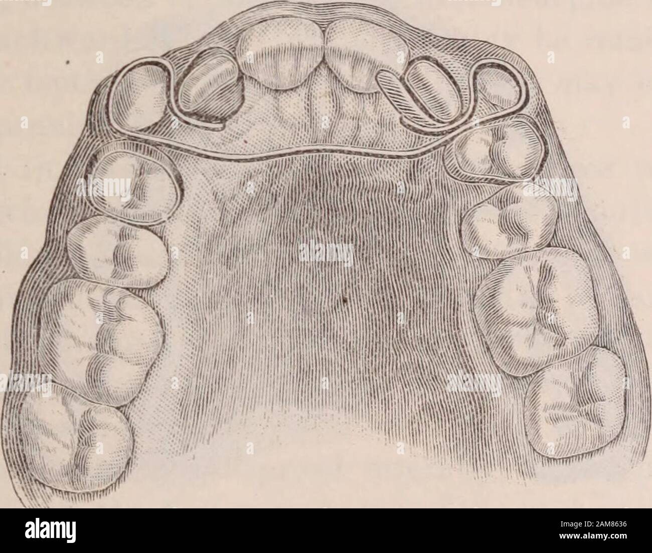 Automorphic Cuspidal Dental cosmos . spring that bears on the cuspid and forces it into line ...