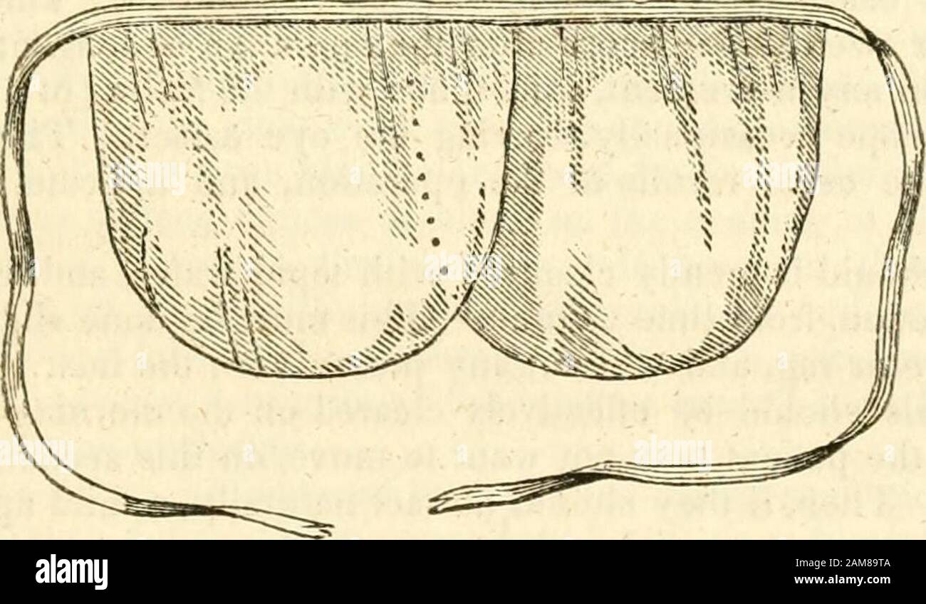 A treatise on the diseases of the eye . d, the lids of both eyesmust be  closed, and kept in that state. The coverings necessary for thispurpose  should be light. Sound eyes