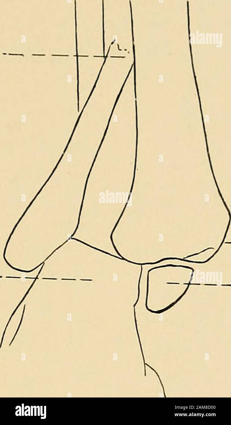 The treatment of fractures . Diaphysis of tibia. Epiphysis. Astragalus. Fig. 539.—Normal ankle-joint, showing epiphyses (anteroposterior view). Figures 535—538 inclusive illustrate a reversed Potts de-formity, the foot having moved inward instead of outward aswell as having fallen backward. Treatment.—The indications for treatment are to place theparts in their normal relations, and to maintain them so untilrepair is completed, guarding against both the lateral and theposterior deformities. If for any reason, such as the presenceof very great swelling of the ankle, it is expedient to delay re- Stock Photo