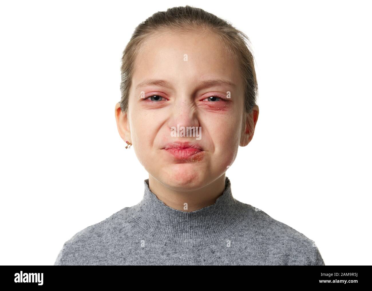 Allergic reaction, skin rash, close view portrait of a girl's face. Redness and inflammation of