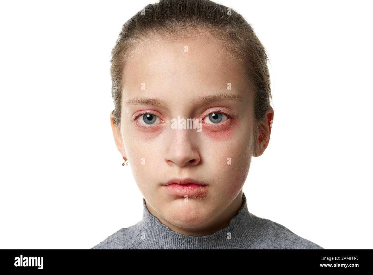 Allergic reaction, skin rash, close view portrait of a girl's face. Redness and inflammation of