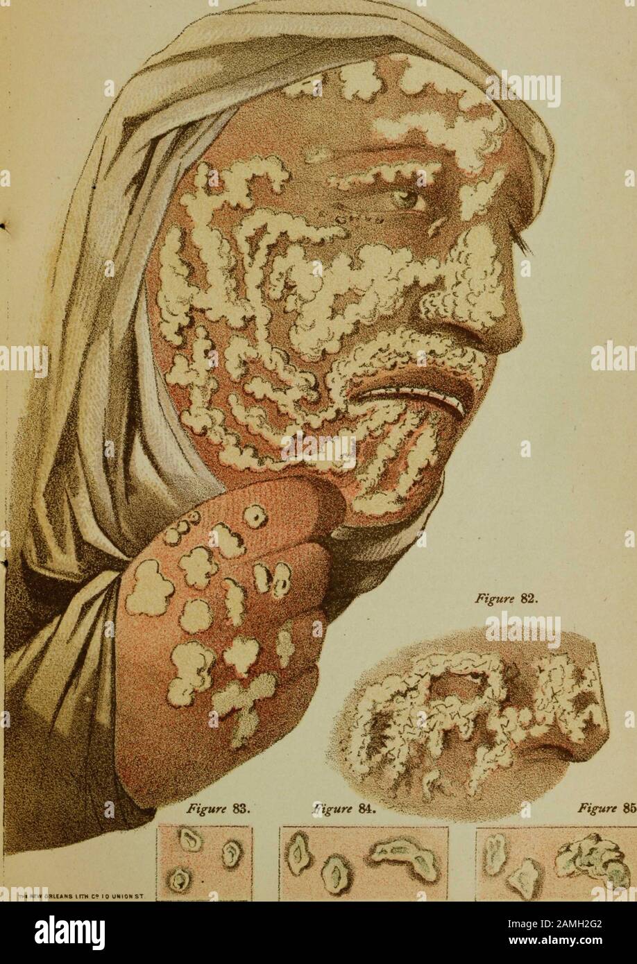 Illustration of a person with smallpox on their face and hands, from the book 'Contagious and Infectious Disease' by author Joseph Jones et al, published by L. Jastremski, 1884. Courtesy Internet Archive. () Stock Photo