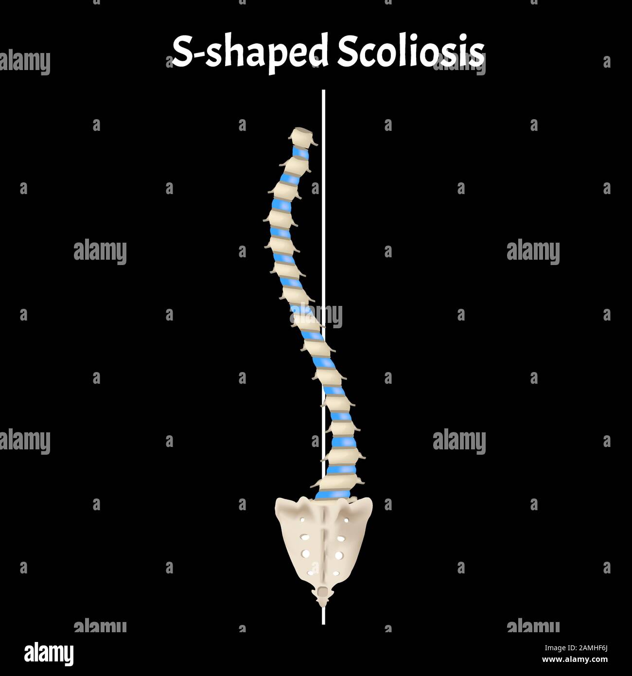 Dextroscoliosis Stock Vector Images - Alamy