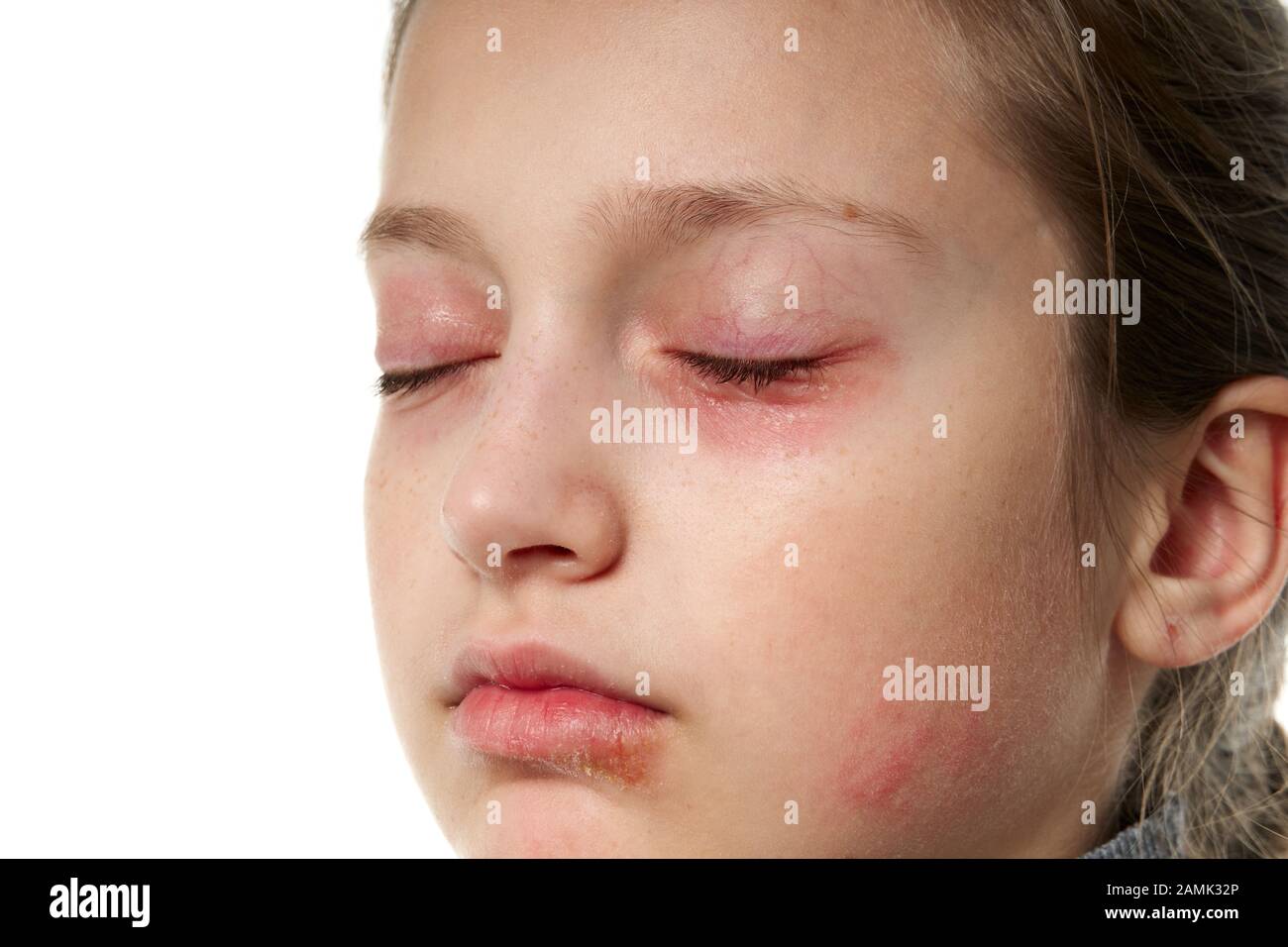 Allergic reaction face lips hires stock photography and images Alamy