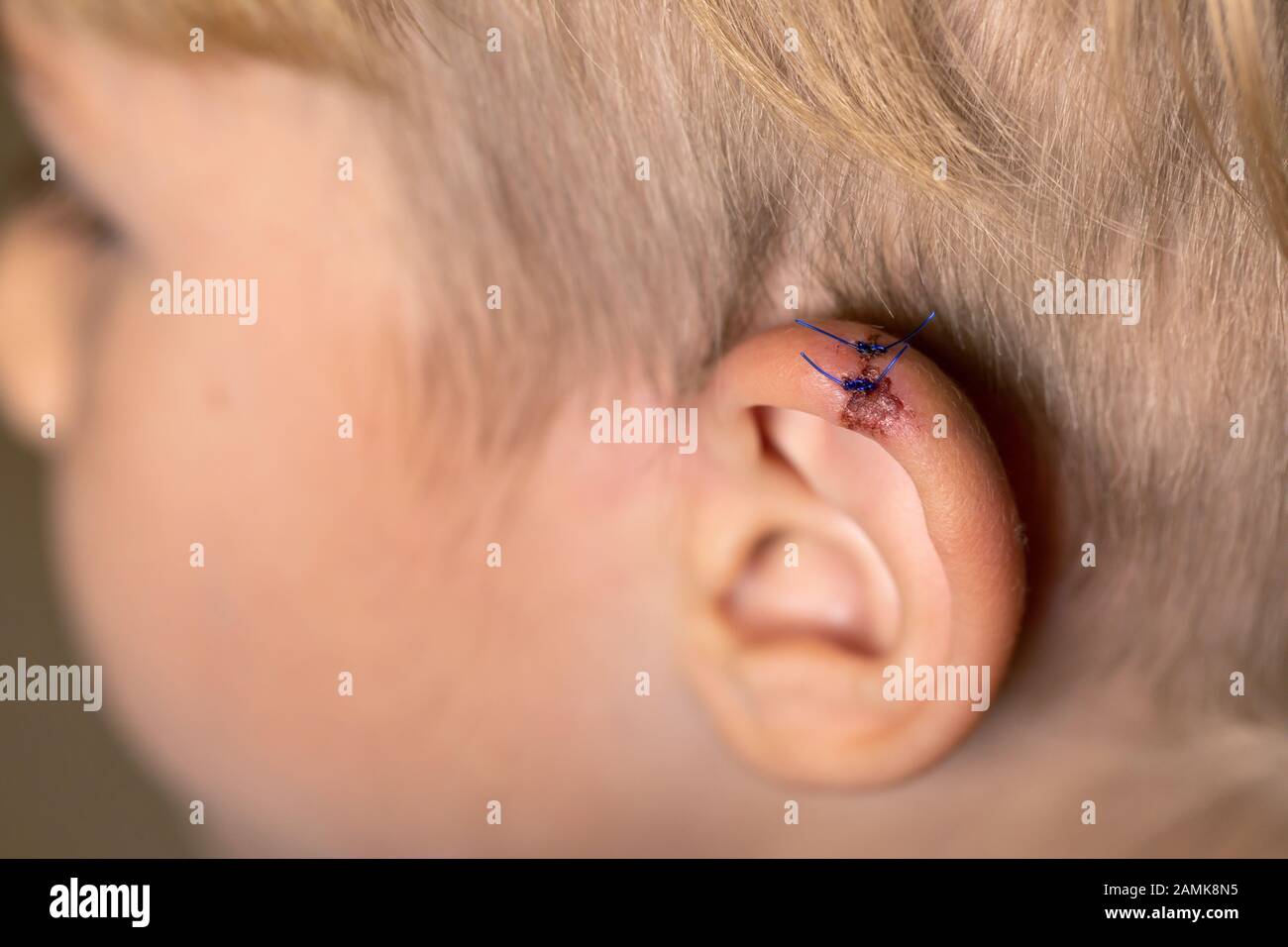 Torn wounds with stitches one child ear. close-up of laceration human ear with suture. wound stitches. Medical, surgical concept. Stock Photo
