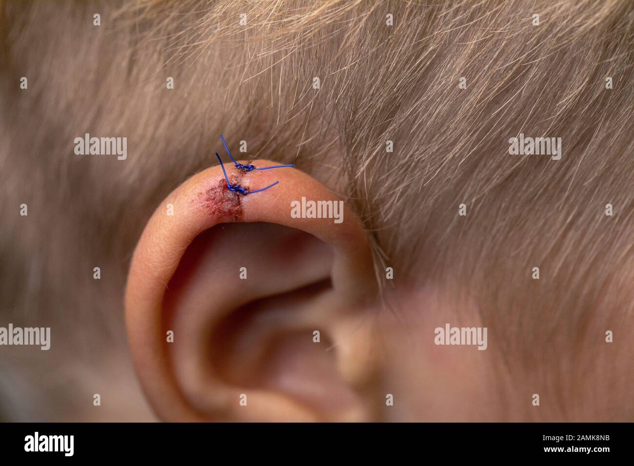 Wound stitches. Medical, surgical concept. Torn wounds with stitches on child ear. close-up of laceration human ear with suture. Stock Photo