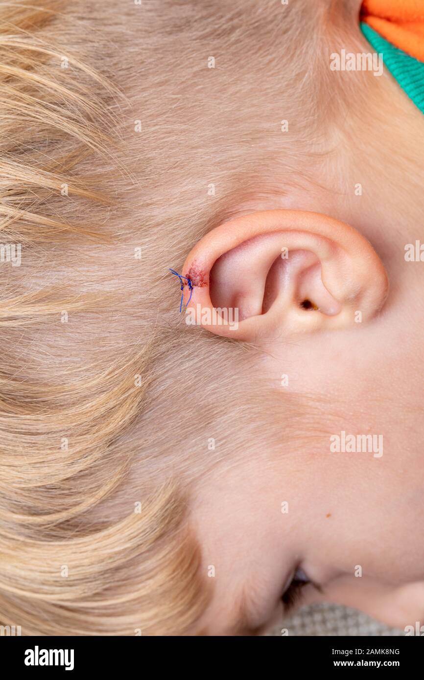 Bleeding ear hires stock photography and images Alamy