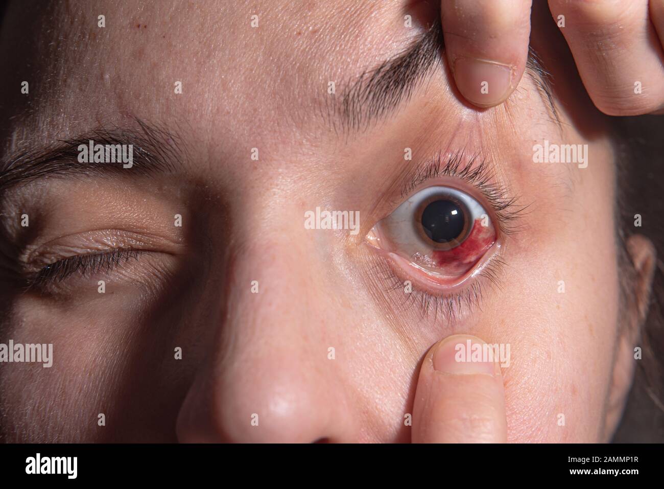 Hemorrhage In The Eye Of A Woman Bruising Of The Cornea Macro Stock