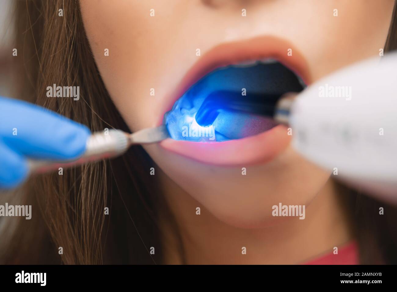 Dental restoration in dentistry with a photopolymer lamp. The girl at