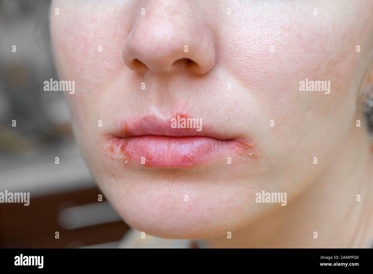 Herpes virus on the lips of young woman. Peeling and remaining blisters